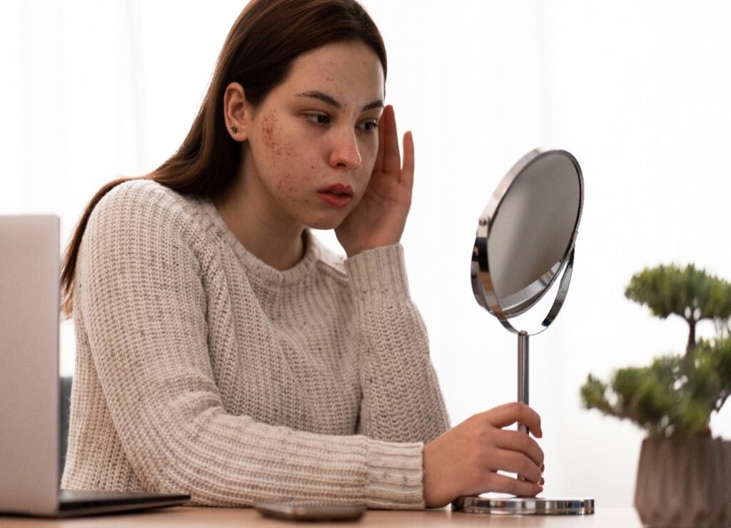acne polycystic ovary syndrome